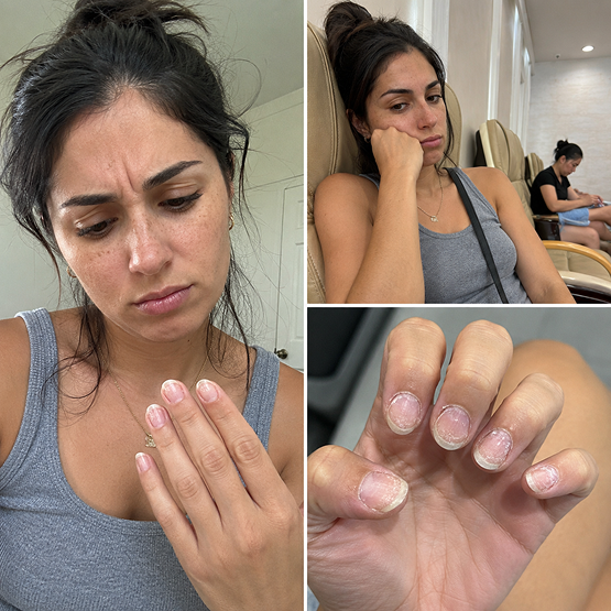 Frustrated woman with damaged nails after a salon visit